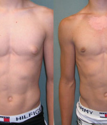 Puffy teen bitchtits medical fetish