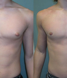 Puffy teen bitchtits medical fetish 577aca477d11b.jpg