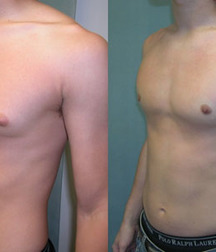 Puffy teen bitchtits medical fetish 577aca4820411.jpg