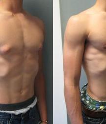 Puffy teen bitchtits medical fetish 577aca4e61274.jpg