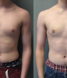 Puffy teen bitchtits medical fetish 577aca4f10043.jpg